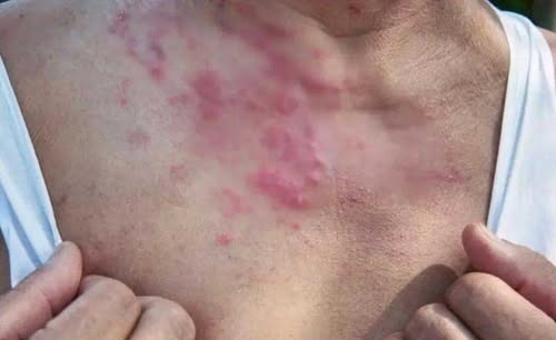 Η ασθένεια που μπορεί να ενεργοποιηθεί από το άγχος και λίγοι γνωρίζουν