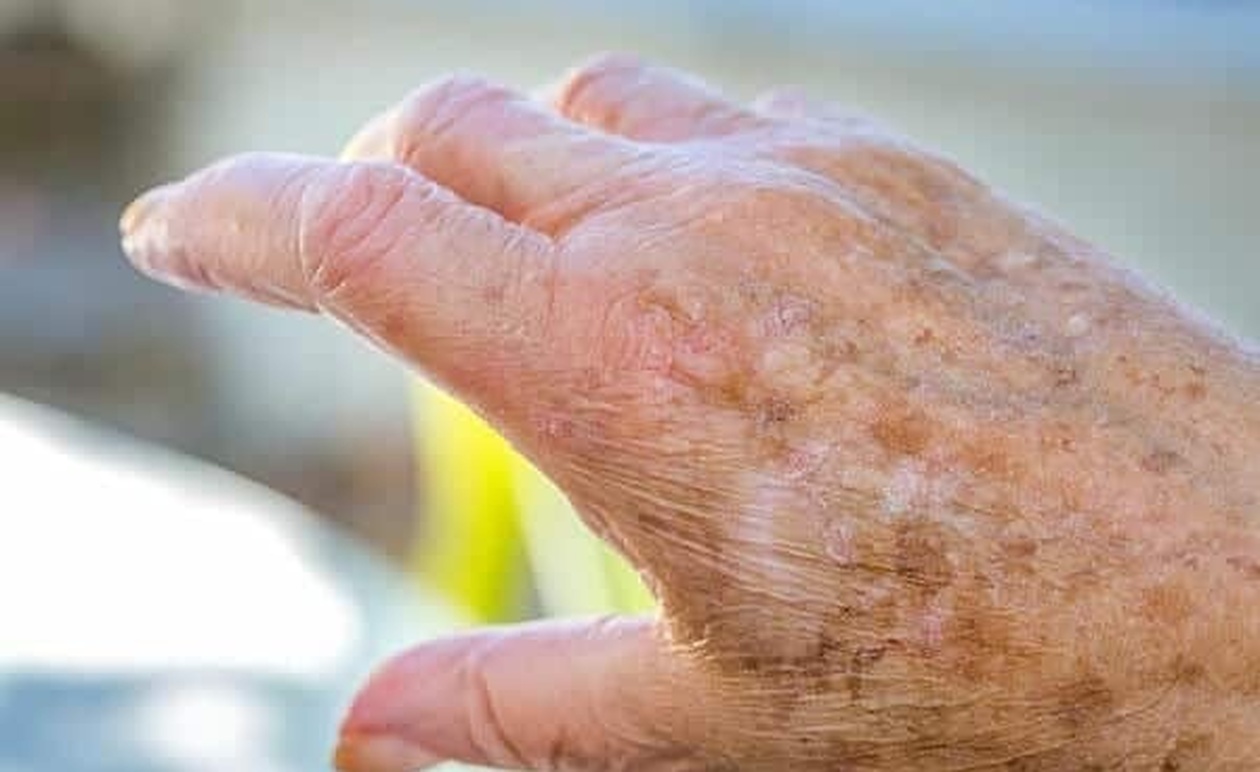 Γιατί εμφανίζονται καφέ κηλίδες στα χέρια – Αιτίες, πρόληψη και φυσικοί τρόποι αντιμετώπισης